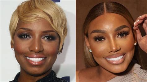 NeNe Leakes Plastic Surgery Before And After Photos